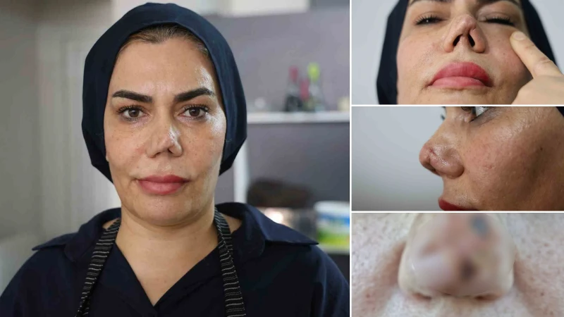 Bakım merkezinde burnu kırıldı: İyileşmek için geçirdiği 4 operasyon sonrası hayatı kabusa döndü